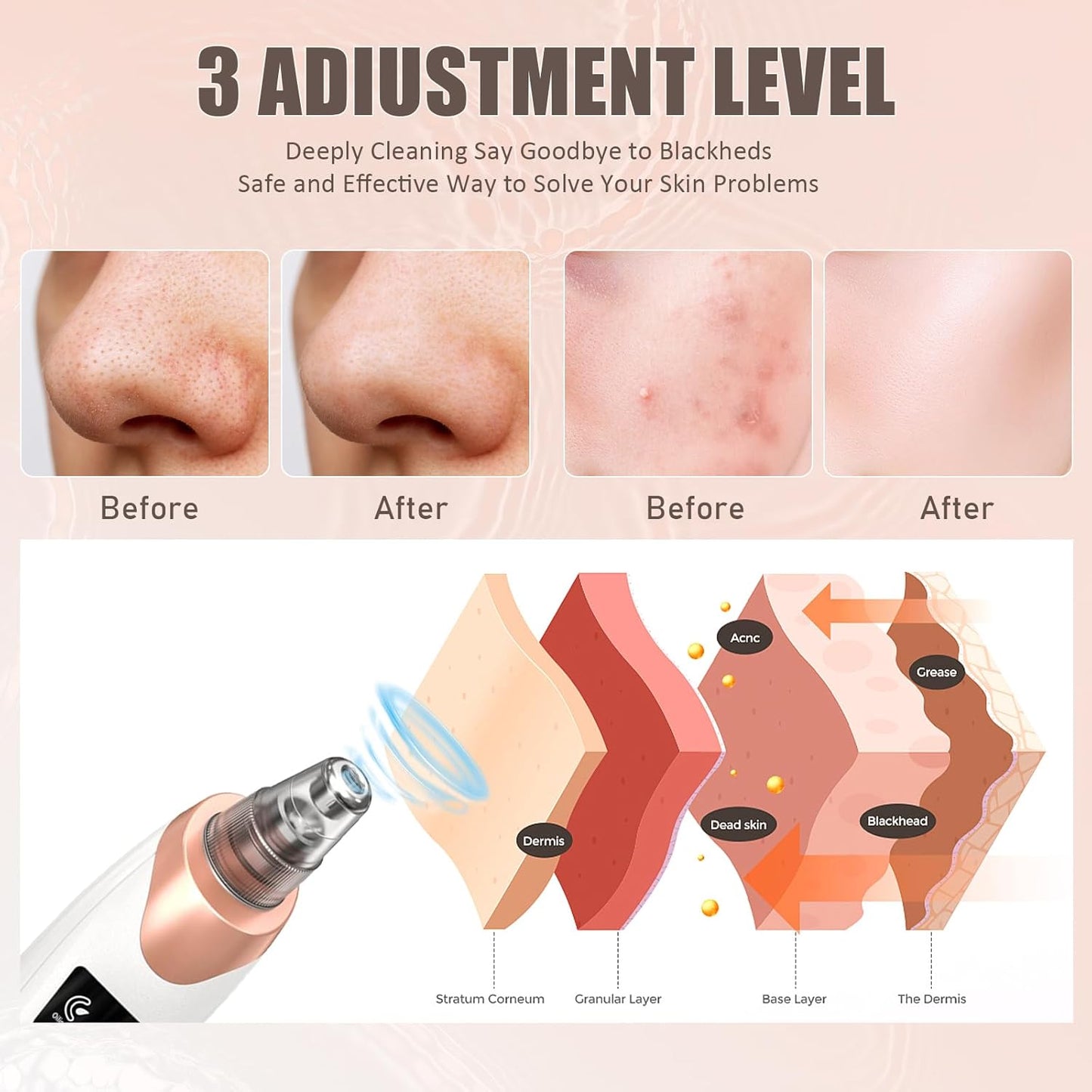 PoreClean™ Blackhead Vacuum Remover